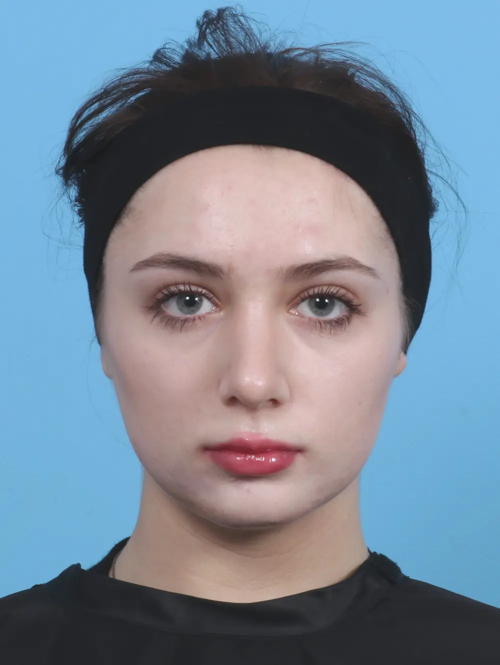 Rhinoplasty Patient Photo - Case 29830 - after view-2