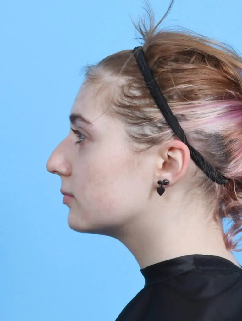 Rhinoplasty - Case 29830 - Before