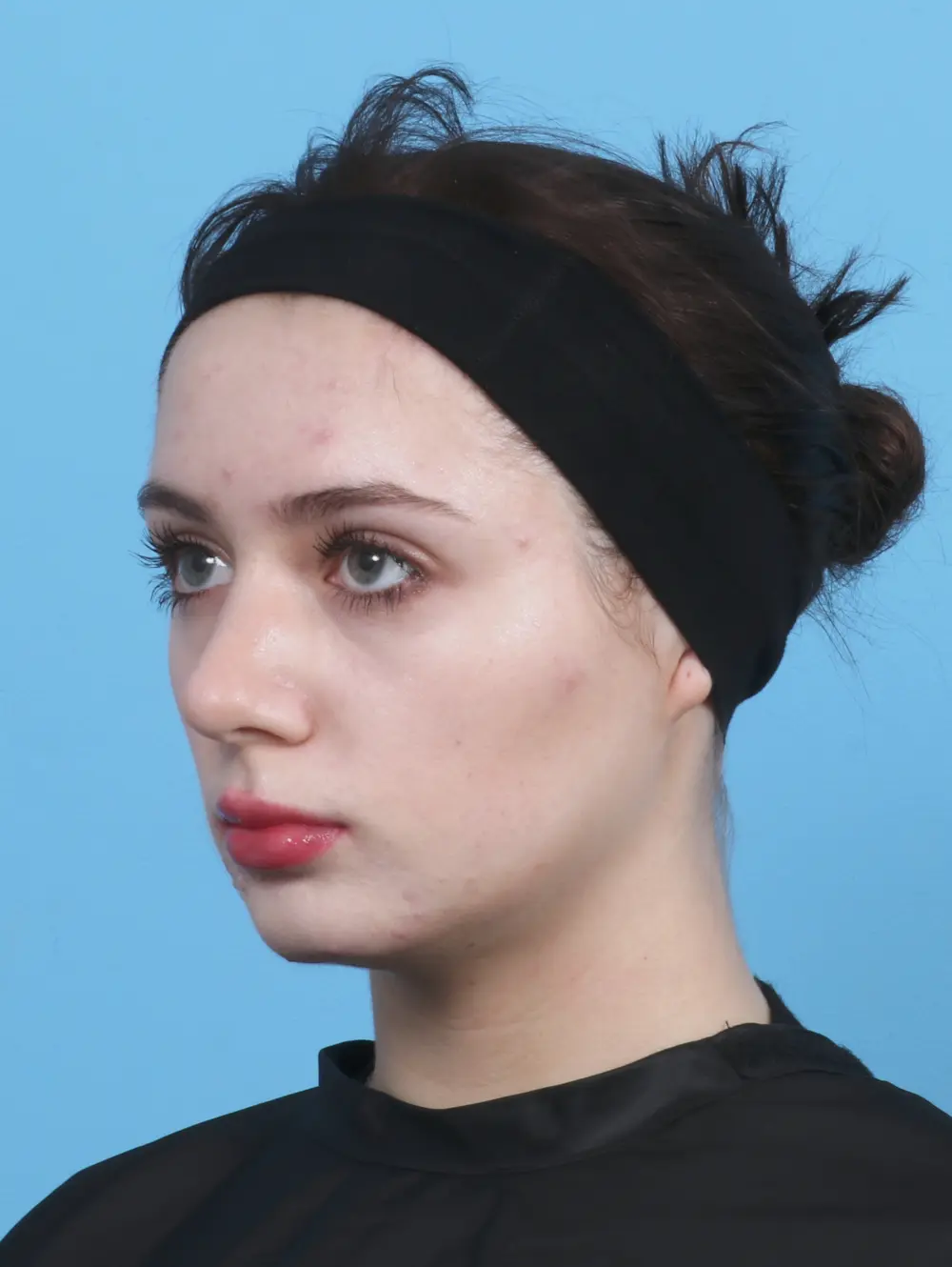 Rhinoplasty Patient Photo - Case 29830 - after view-1