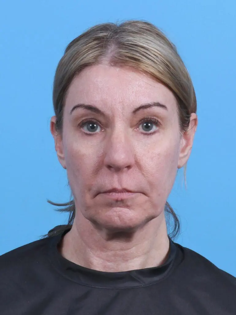 Facelift / Neck Lift - Case 29838 - Before
