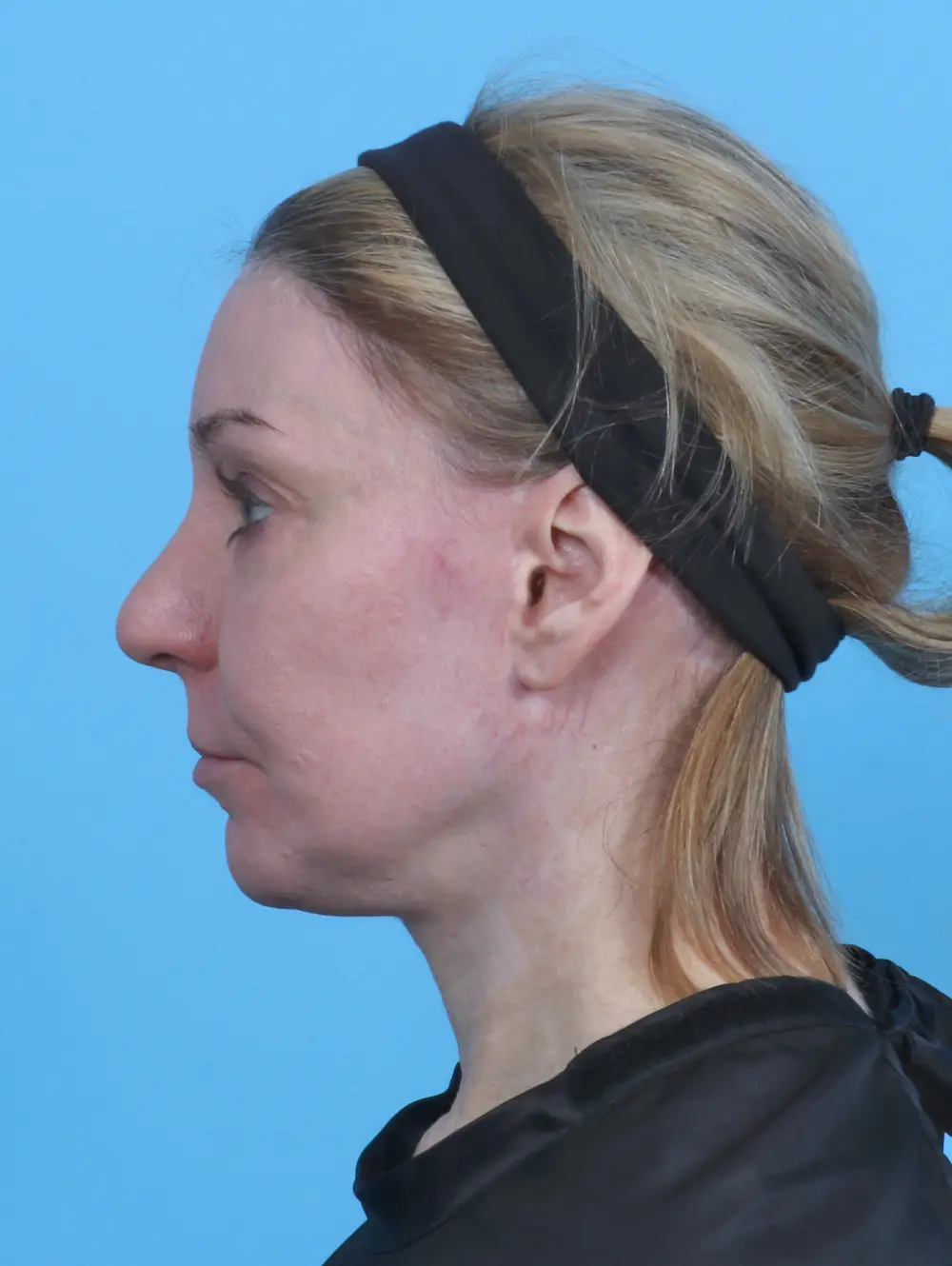 Facelift / Neck Lift Patient Photo - Case 29838 - after view-2