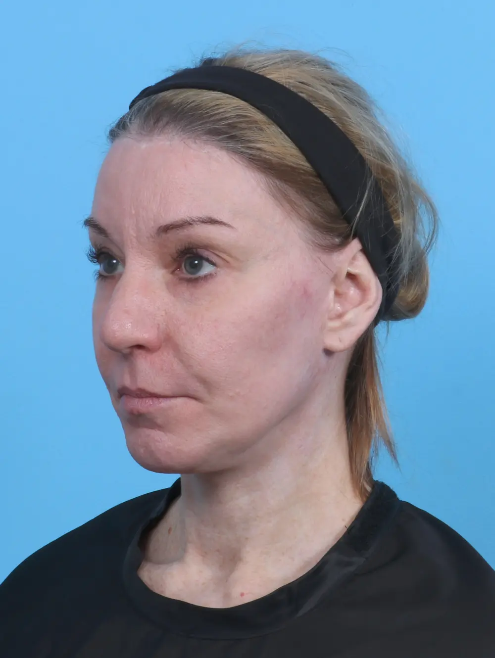 Facelift / Neck Lift Patient Photo - Case 29838 - after view-1