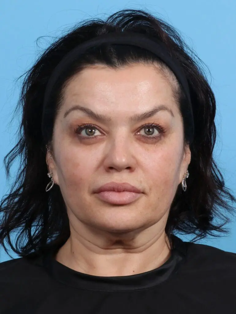 Eyelid Surgery - Case 29872 - Before