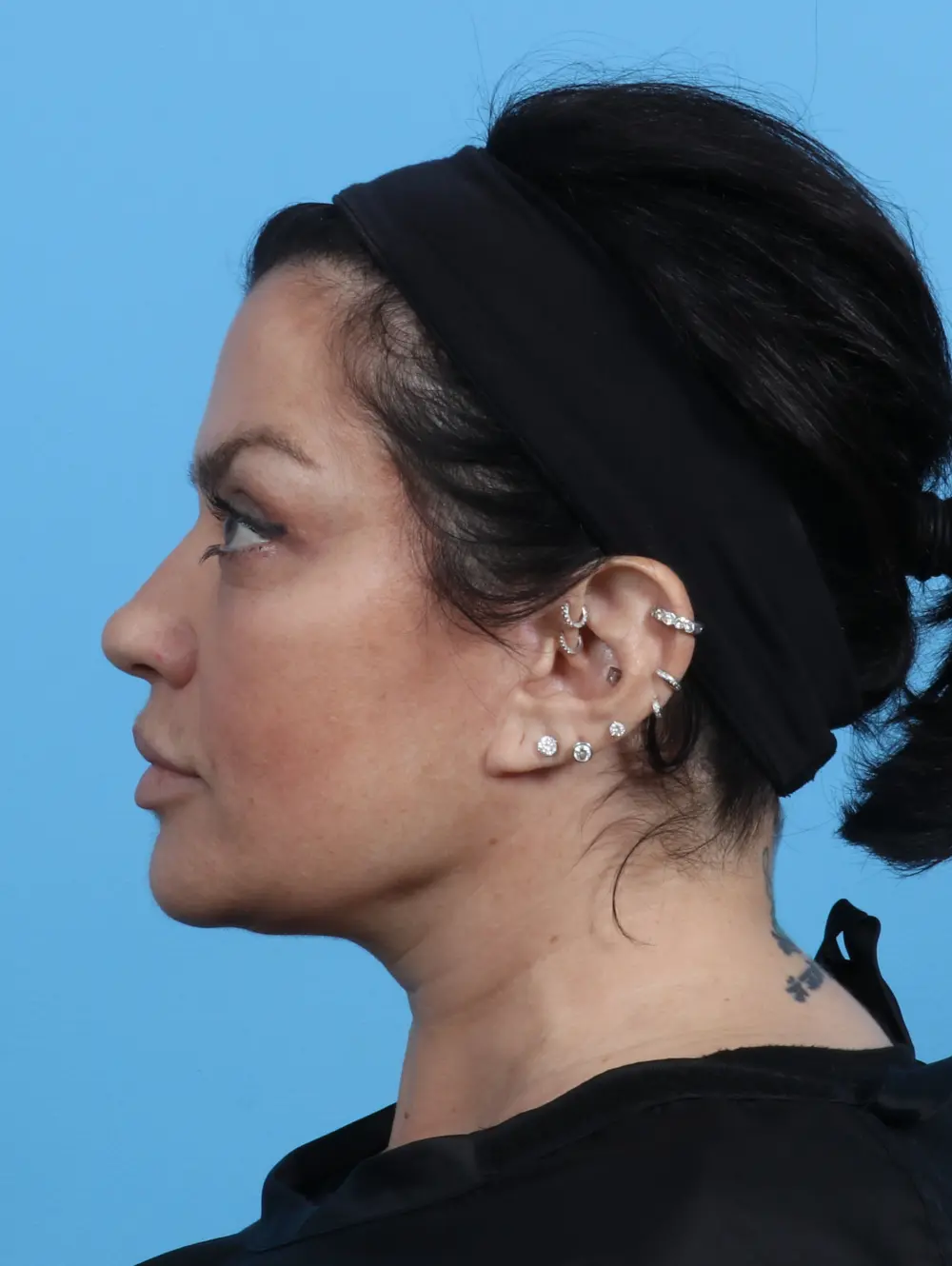 Eyelid Surgery Patient Photo - Case 29872 - after view-2