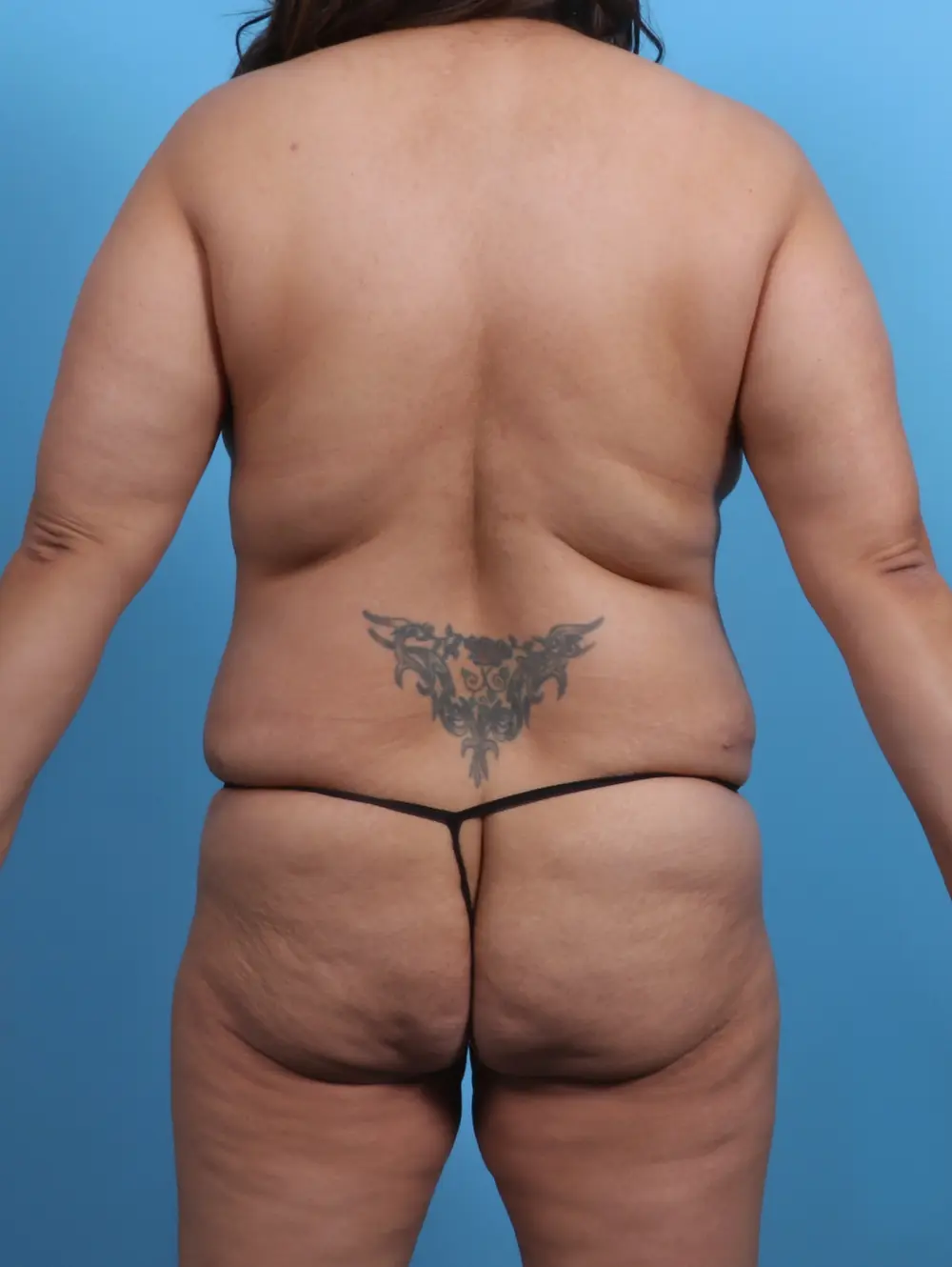 Tummy Tuck Patient Photo - Case 29888 - after view-3