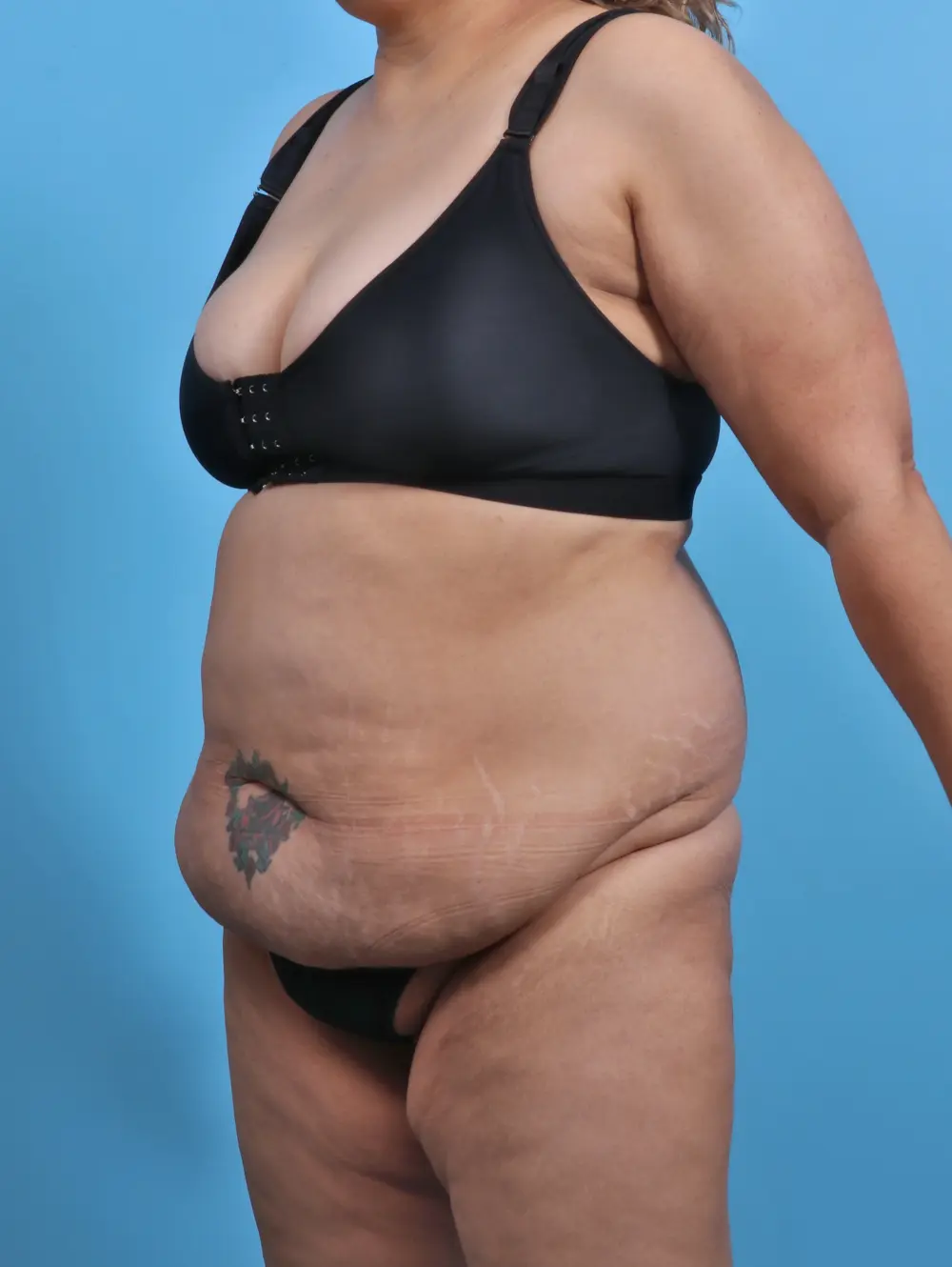 Tummy Tuck Patient Photo - Case 29888 - before view-1
