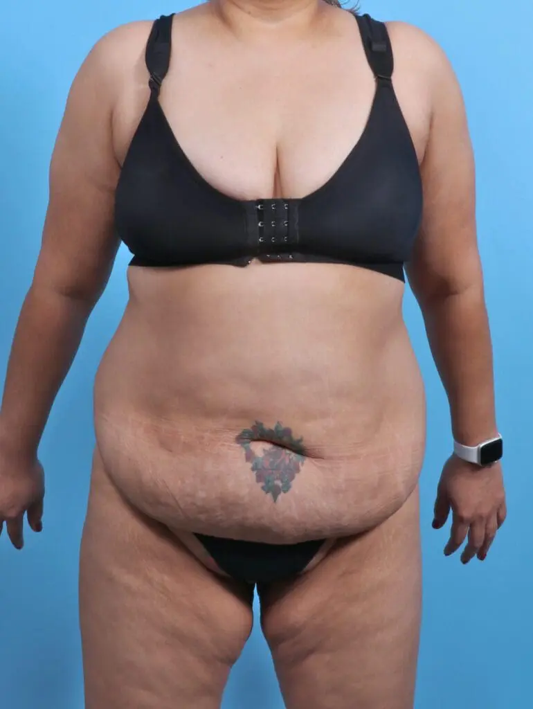 Tummy Tuck - Case 29888 - Before