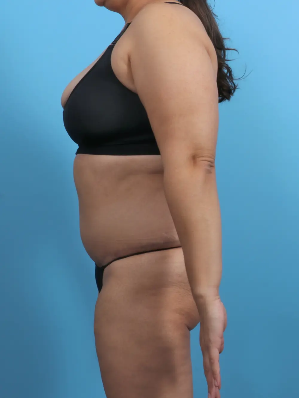 Tummy Tuck Patient Photo - Case 29888 - after view-2