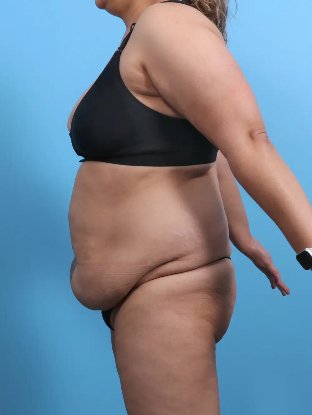 Tummy Tuck Patient Photo - Case 29888 - before view-2