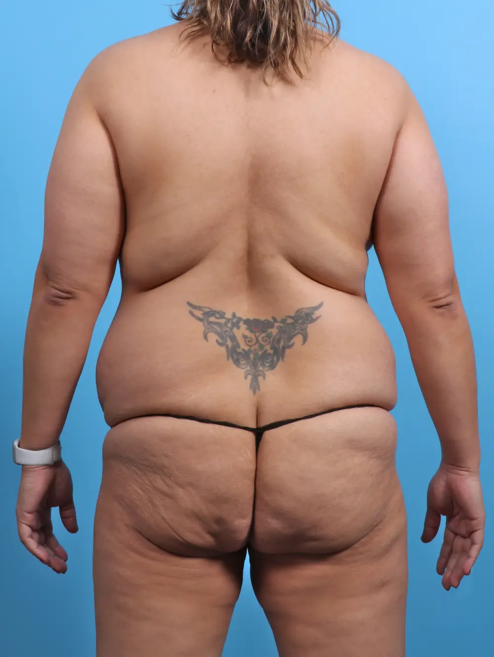 Tummy Tuck Patient Photo - Case 29888 - before view-3