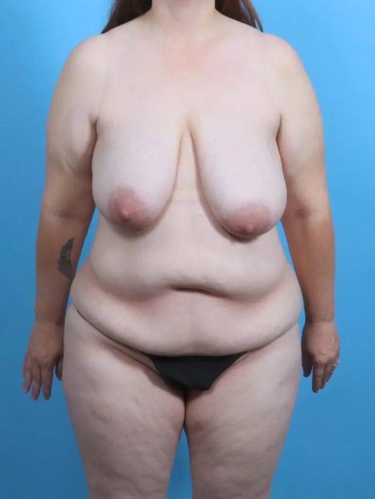 Breast Lift/Reduction w/o Implants - Case 29898 - Before