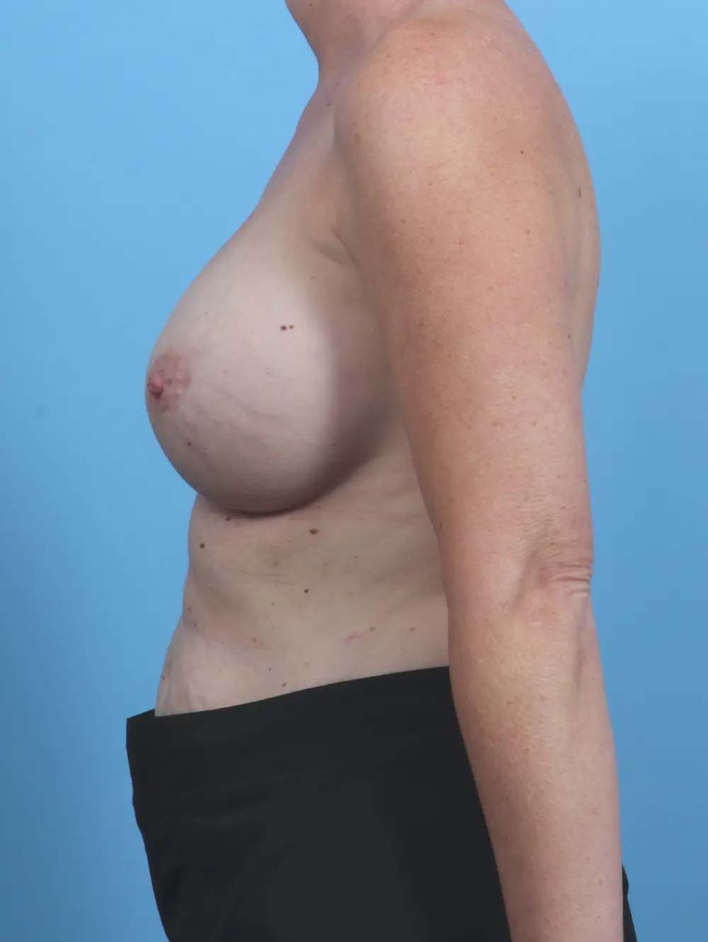 Breast Implant Revision Patient Photo - Case 29947 - after view-2