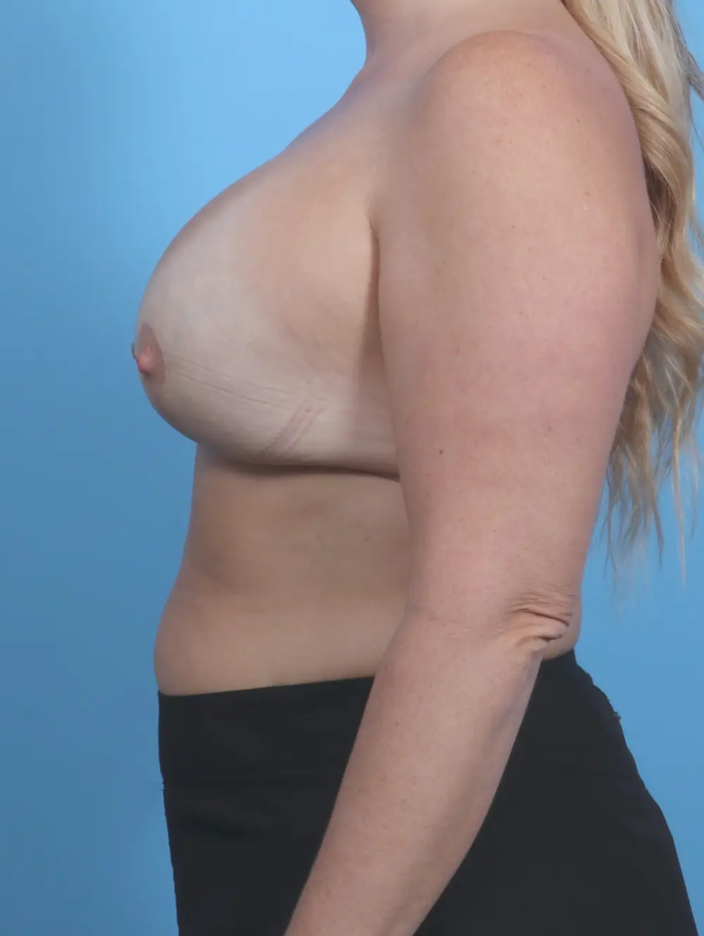 Breast Lift/Reduction with Implants Patient Photo - Case 29955 - after view-2