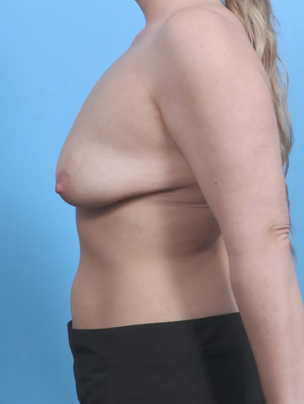 Breast Lift/Reduction with Implants Patient Photo - Case 29955 - before view-2