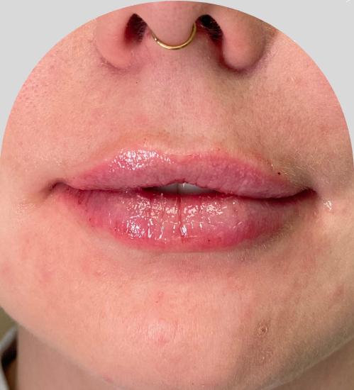 Lip Fillers - Case 29968 - After