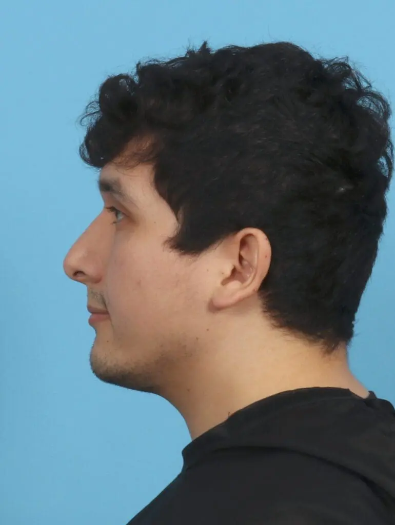 Rhinoplasty - Case 29985 - After