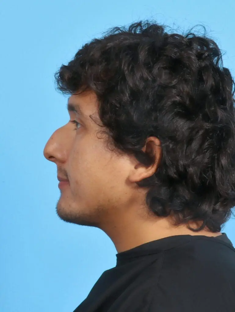 Rhinoplasty - Case 29985 - Before