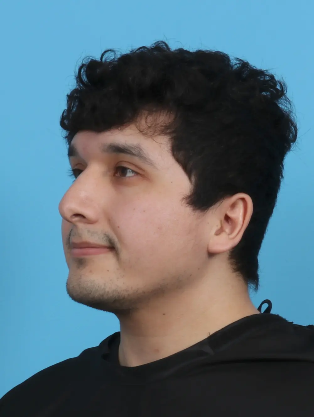 Rhinoplasty Patient Photo - Case 29985 - after view-1