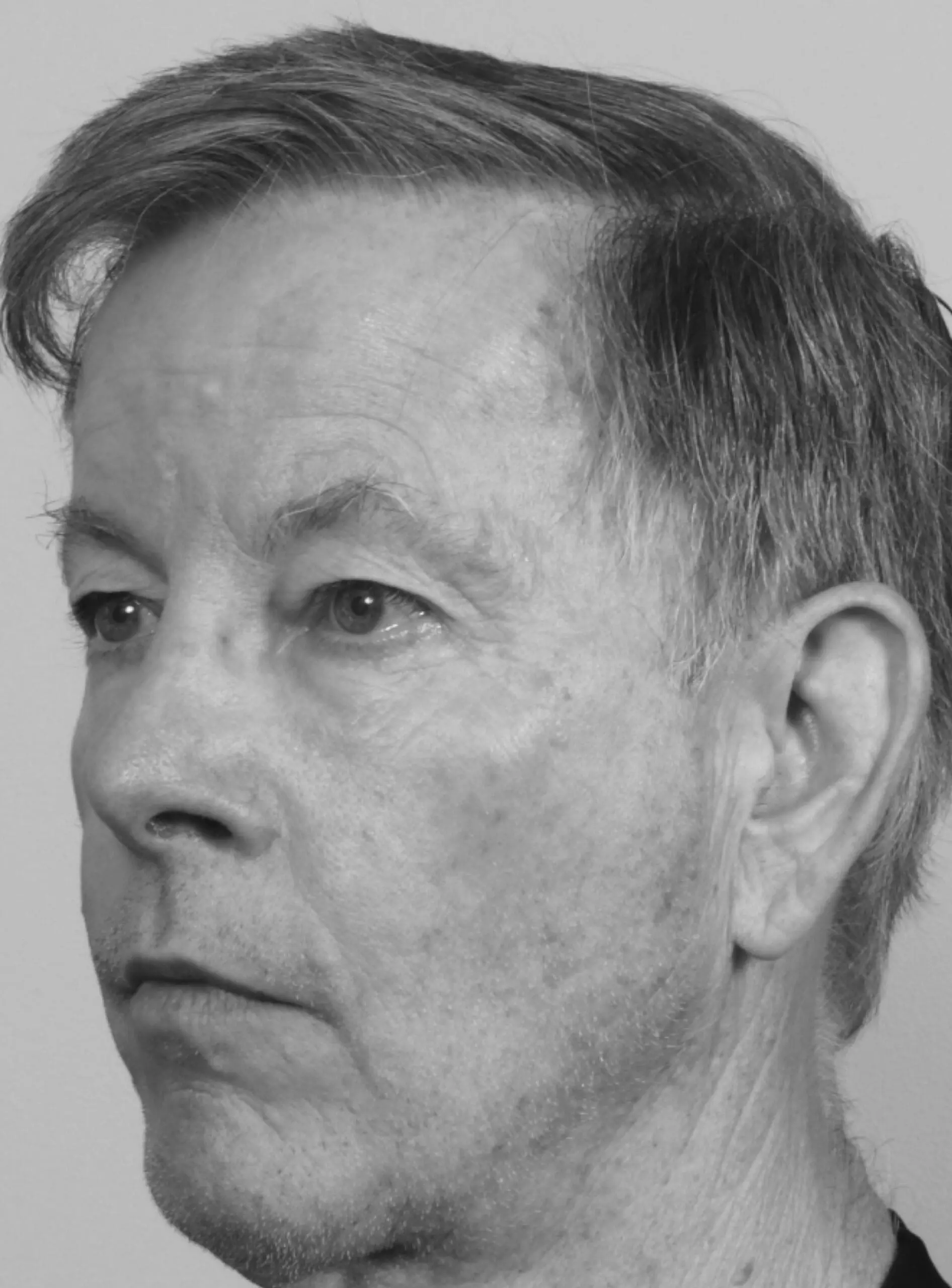 Before Eyelid Surgery