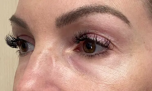 Before Dermal Fillers