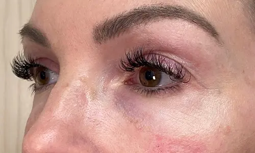 After Dermal Fillers