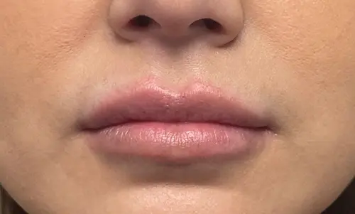 Before Dermal Fillers