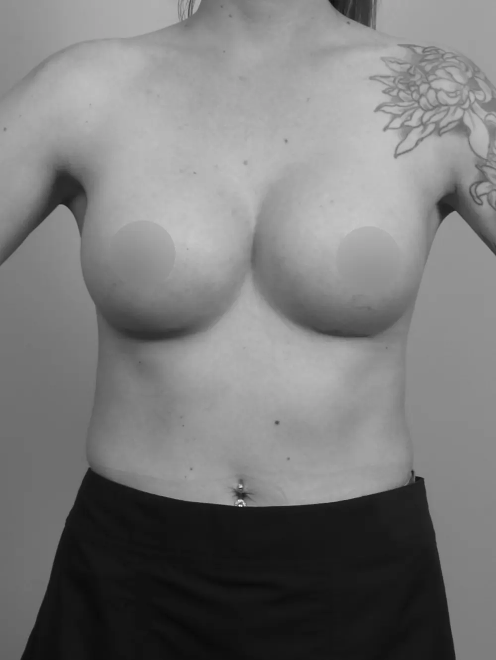 After Breast Augmentation