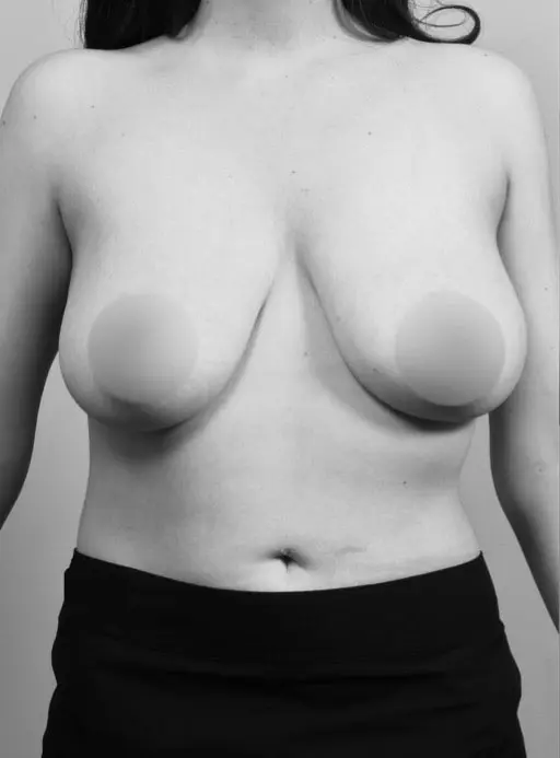 Before Breast Reduction