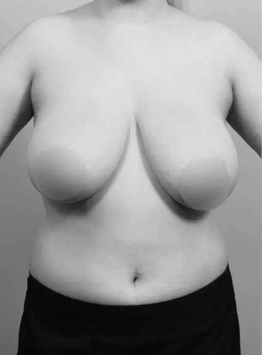 Before Breast Reduction