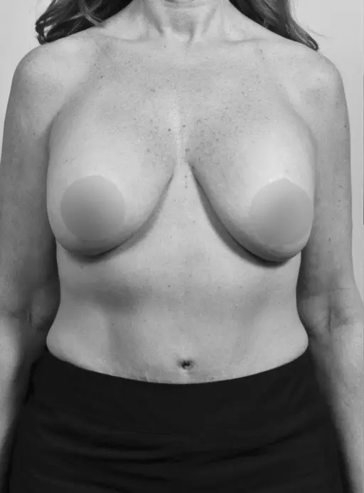 Before Breast Implants