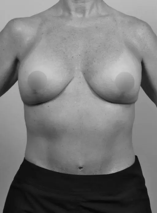 After Breast Implants