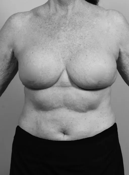 After Breast Implants
