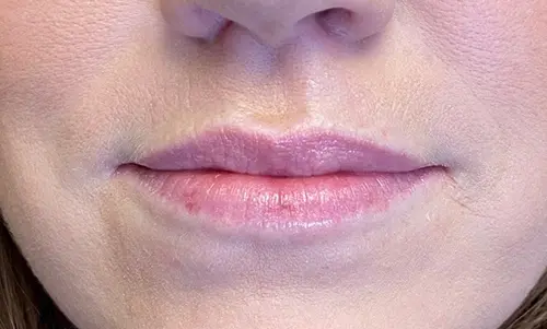 Before Dermal Fillers