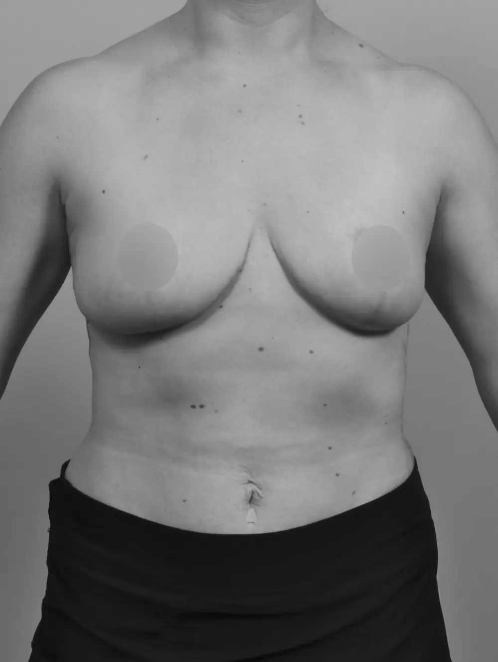 After Breast Lift