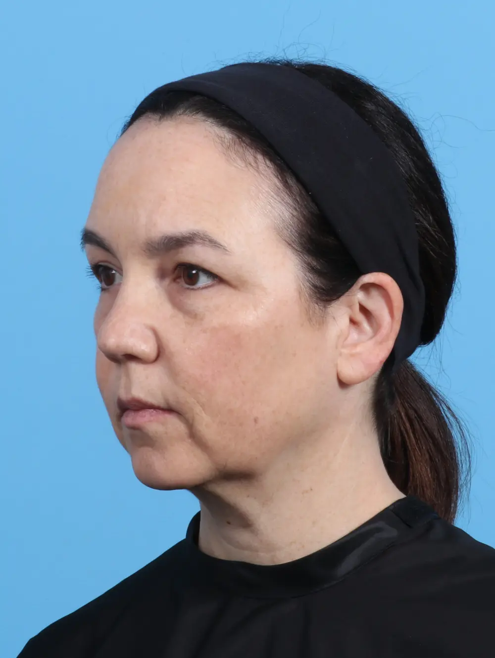 Eyelid Surgery Patient Photo - Case 30131 - before view-1