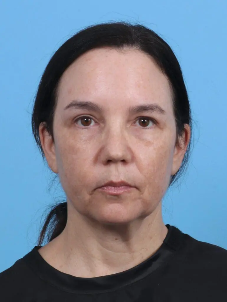 Eyelid Surgery - Case 30131 - After