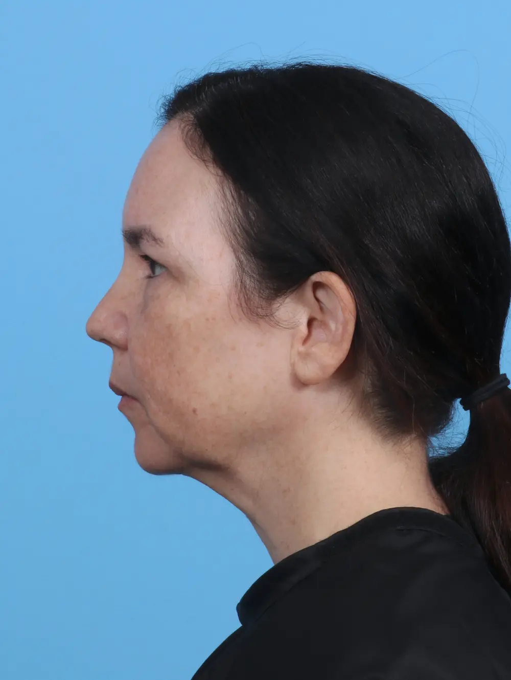 Eyelid Surgery Patient Photo - Case 30131 - after view-2