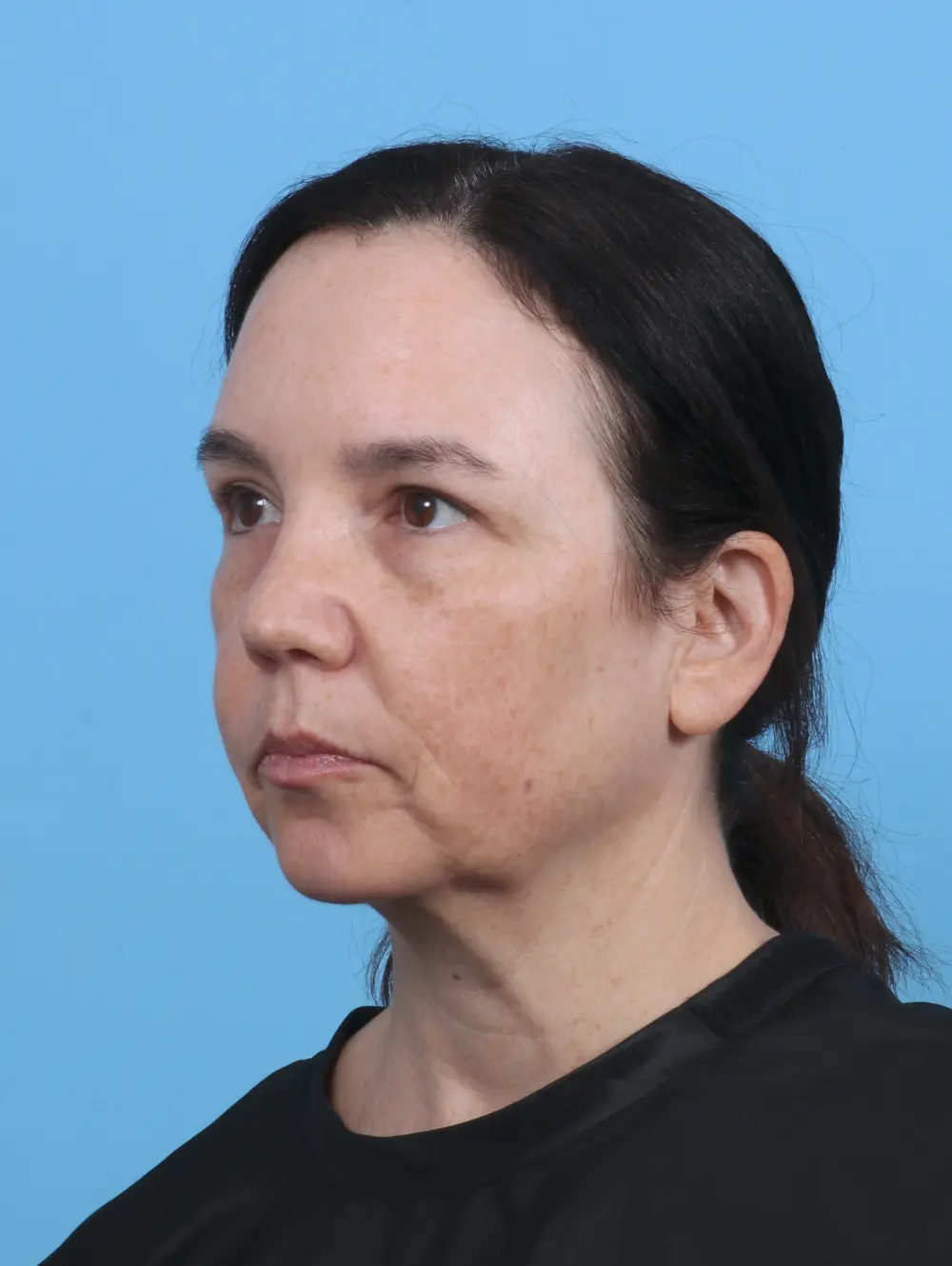 Eyelid Surgery Patient Photo - Case 30131 - after view-1