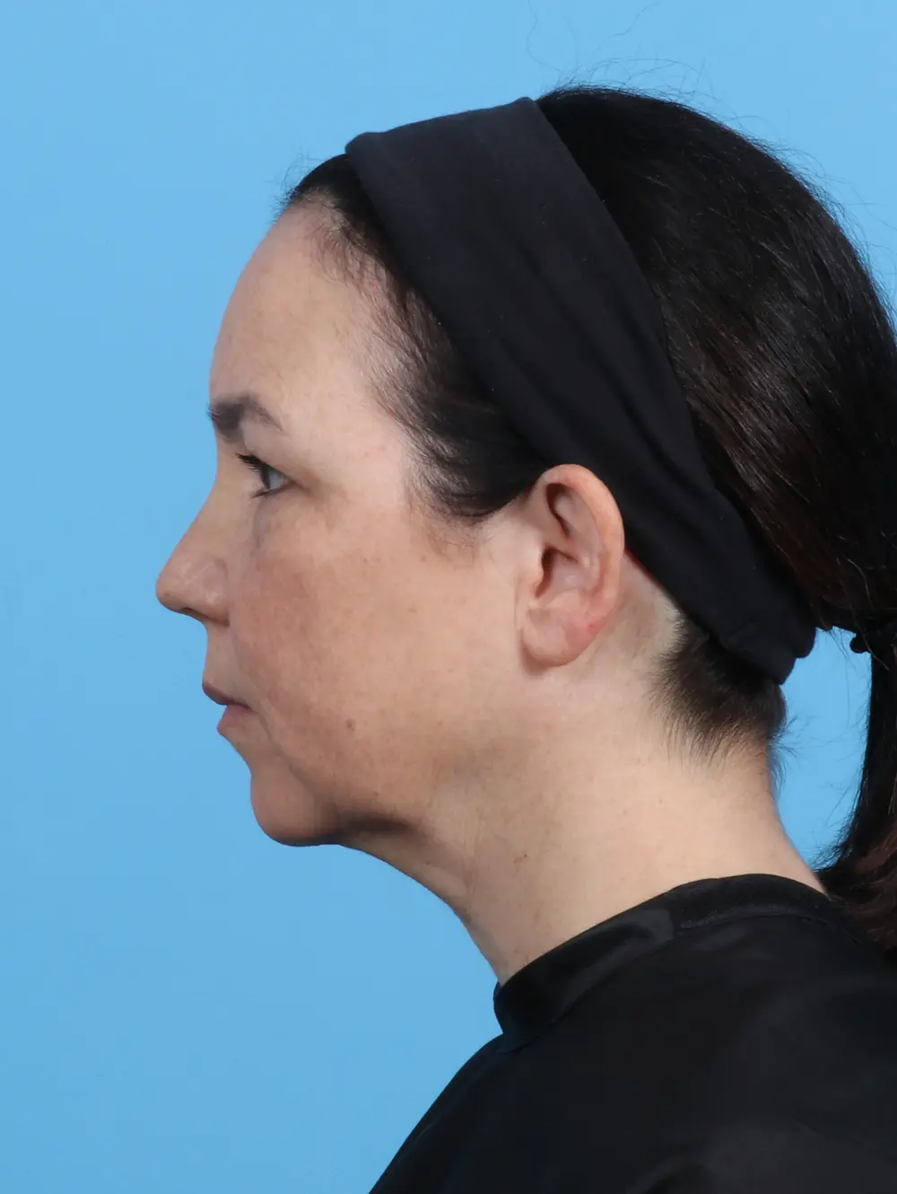 Eyelid Surgery Patient Photo - Case 30131 - before view-2