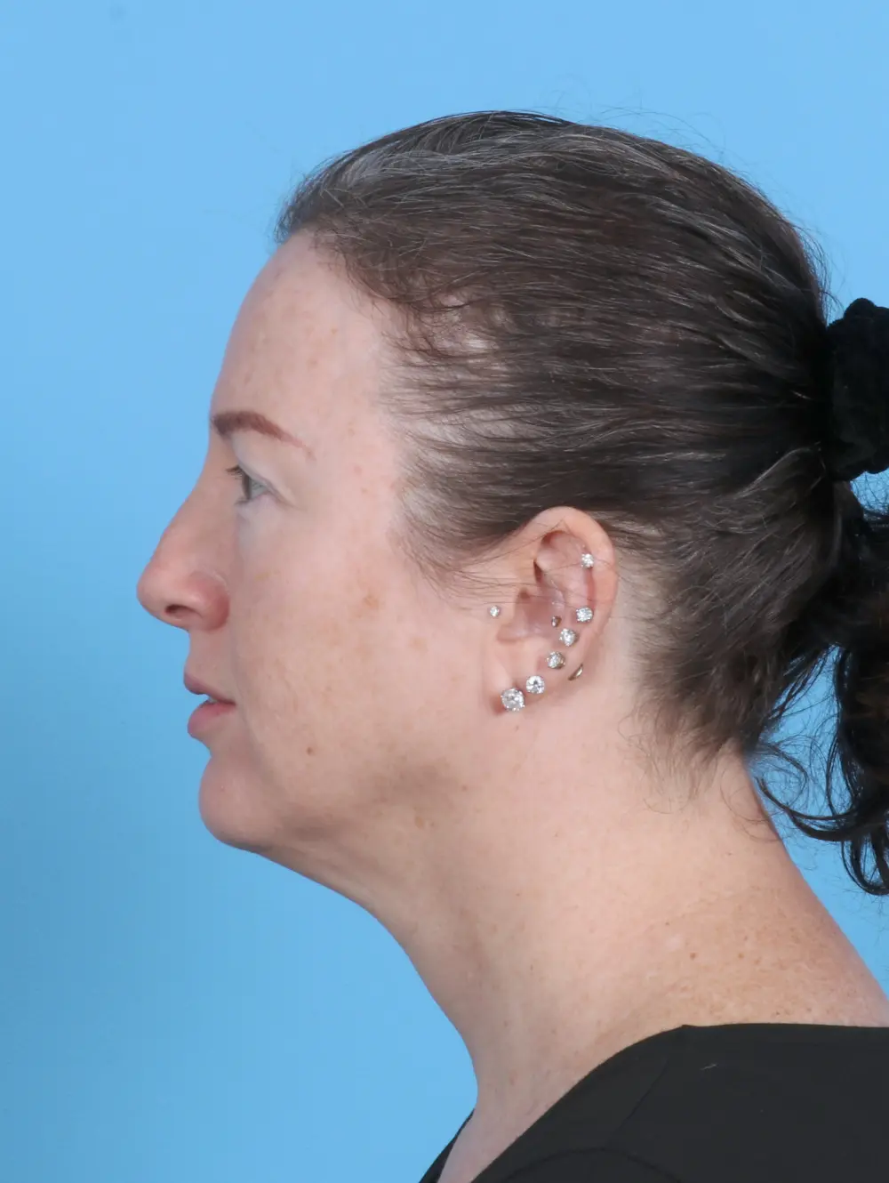 Brow Lift Patient Photo - Case 30047 - after view-2