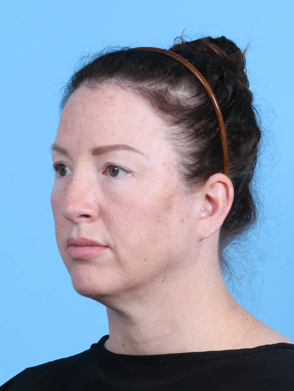 Brow Lift Patient Photo - Case 30047 - before view-1