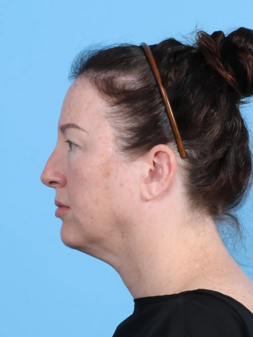 Brow Lift Patient Photo - Case 30047 - before view-2