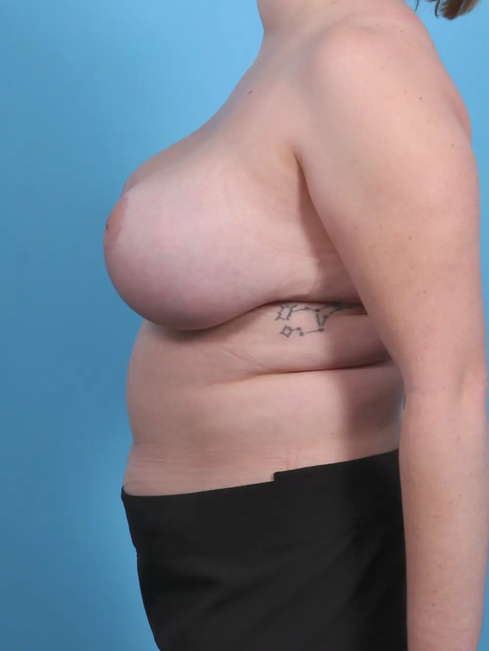 Breast Lift/Reduction w/o Implants Patient Photo - Case 30063 - after view-2