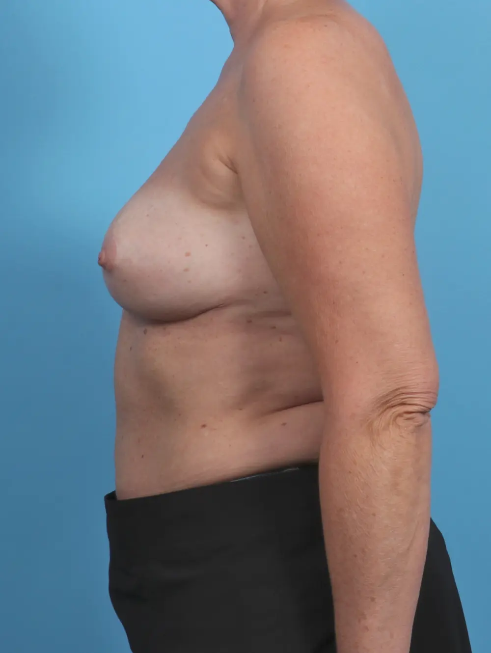 Breast Implant Removal Patient Photo - Case 30263 - after view-2