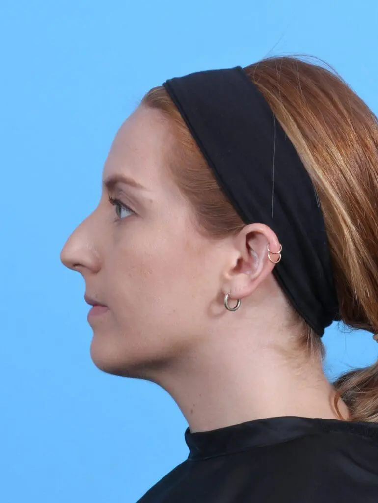 Rhinoplasty - Case 30193 - Before