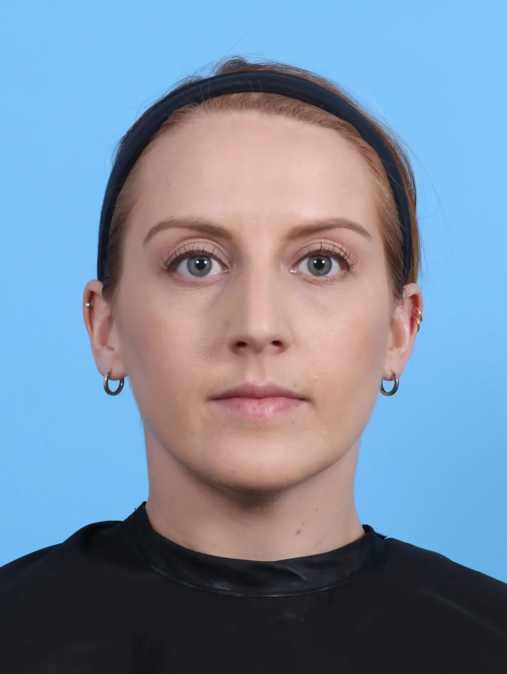 Rhinoplasty Patient Photo - Case 30193 - before view-2