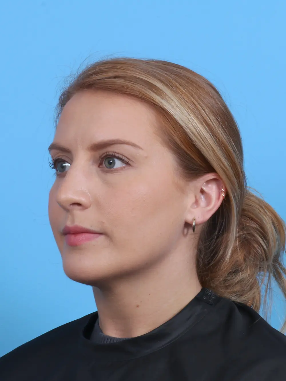 Rhinoplasty Patient Photo - Case 30193 - after view-1