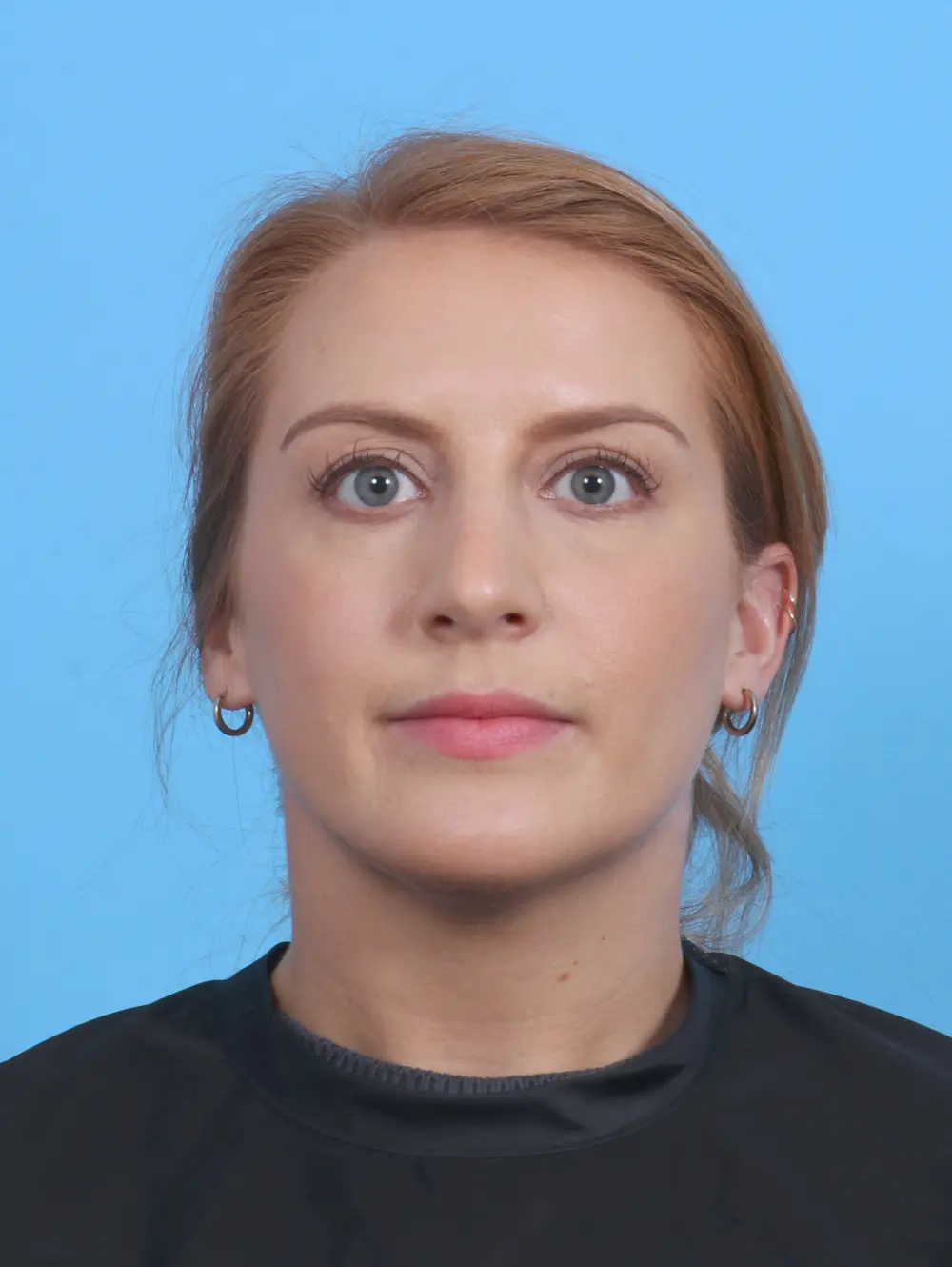 Rhinoplasty Patient Photo - Case 30193 - after view-2