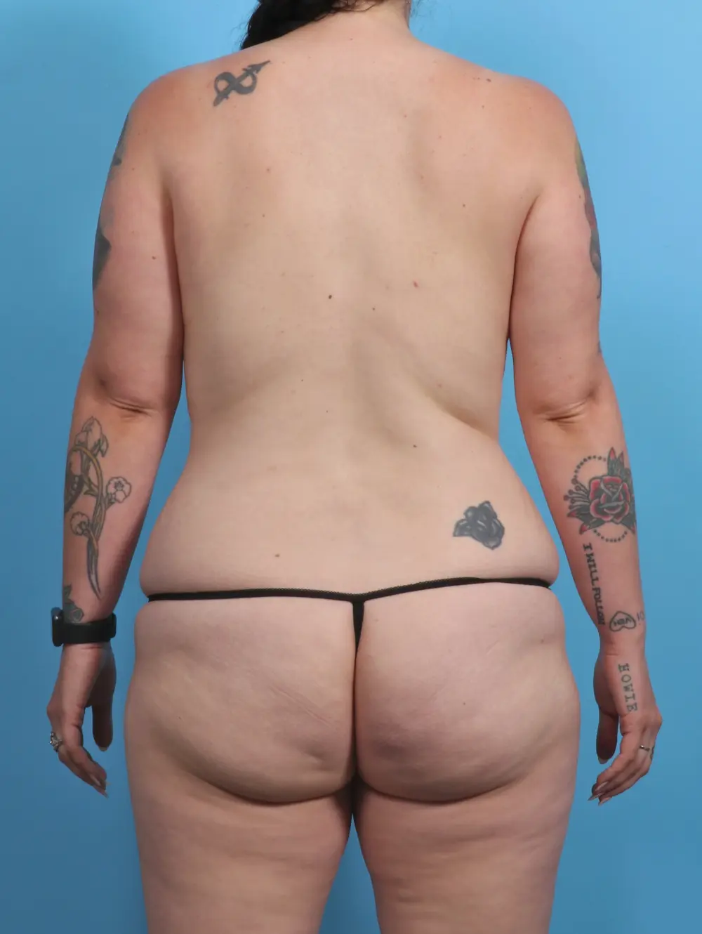 Body Lift Patient Photo - Case 30201 - before view-3