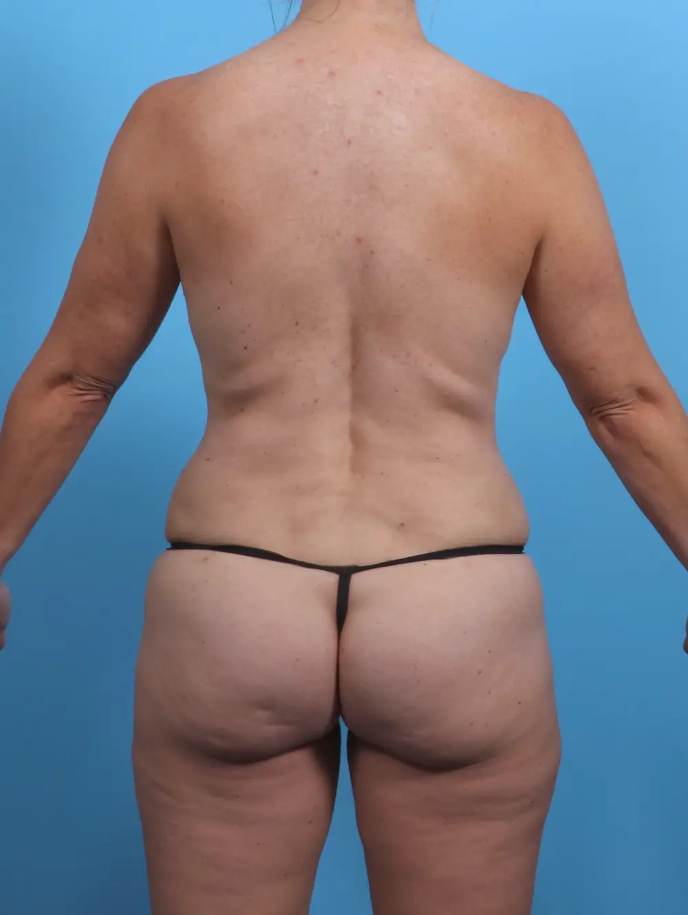 Breast Lift/Reduction with Implants Patient Photo - Case 30212 - after view-3